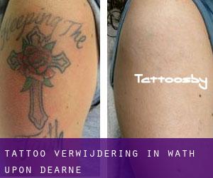 Tattoo verwijdering in Wath upon Dearne