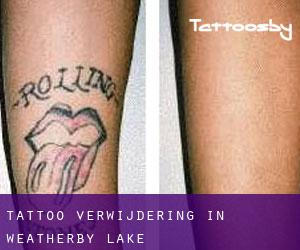 Tattoo verwijdering in Weatherby Lake