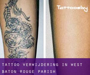 Tattoo verwijdering in West Baton Rouge Parish