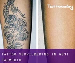 Tattoo verwijdering in West Falmouth