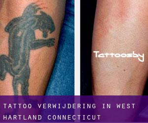Tattoo verwijdering in West Hartland (Connecticut)