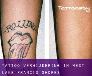Tattoo verwijdering in West Lake Francis Shores