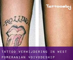 Tattoo verwijdering in West Pomeranian Voivodeship
