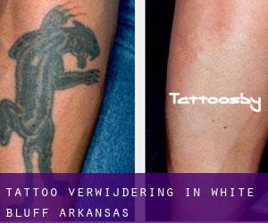 Tattoo verwijdering in White Bluff (Arkansas)