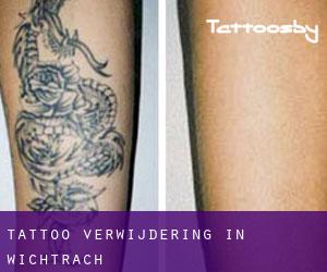 Tattoo verwijdering in Wichtrach