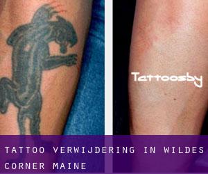 Tattoo verwijdering in Wildes Corner (Maine)