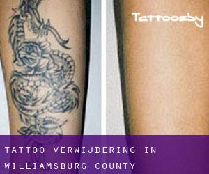 Tattoo verwijdering in Williamsburg County