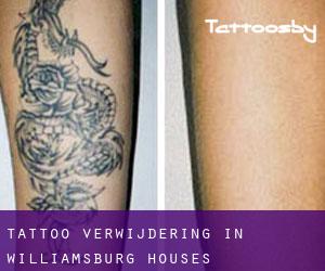 Tattoo verwijdering in Williamsburg Houses