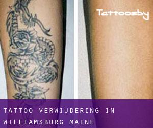Tattoo verwijdering in Williamsburg (Maine)