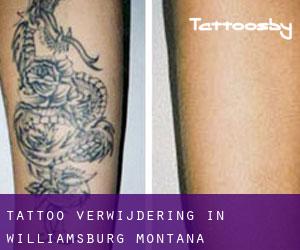 Tattoo verwijdering in Williamsburg (Montana)