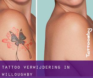 Tattoo verwijdering in Willoughby