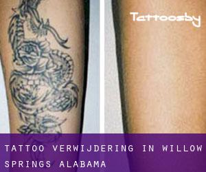 Tattoo verwijdering in Willow Springs (Alabama)