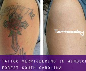 Tattoo verwijdering in Windsor Forest (South Carolina)