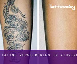 Tattoo verwijdering in Xiuying