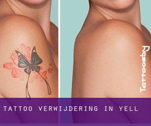 Tattoo verwijdering in Yell