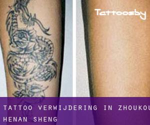 Tattoo verwijdering in Zhoukou (Henan Sheng)